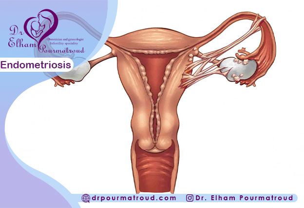 Endometriosis